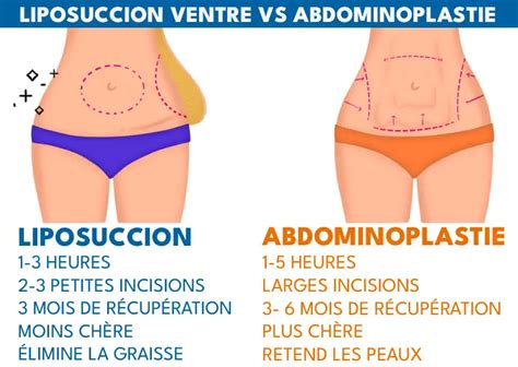 Liposuccion Du Ventre Tunisie Prix Lipoaspiration Abdominale Tunisie