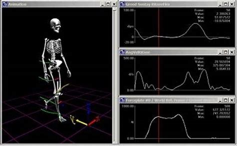 3d Gait Analysis Could Help Avoid Need For Surgery