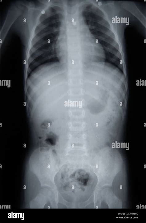 X Ray Of Pediatric Chest Abdomen And Pelvis Stock Photo Alamy