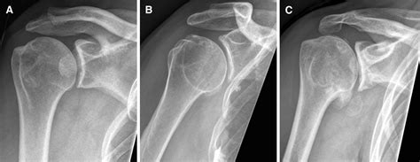 Glenohumeral Joint Arthritis