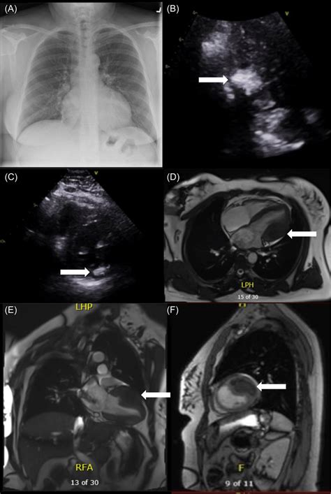 Preoperative Chest Xray Demonstrating Mild Left Ventricular Lv