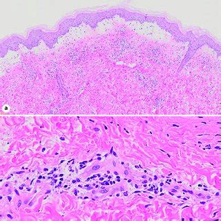 A Vesiculobullous Lesions And Erythematous Macules On The Lower Legs