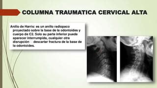 Columna Traumatica Cervical Alta Ppt