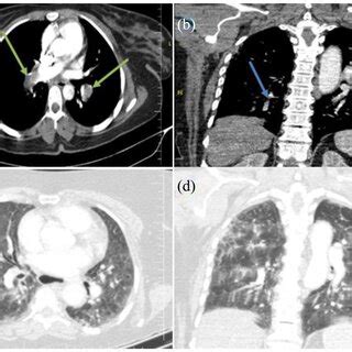 Chest computerized tomography angiography (CTA) was obtained and ...