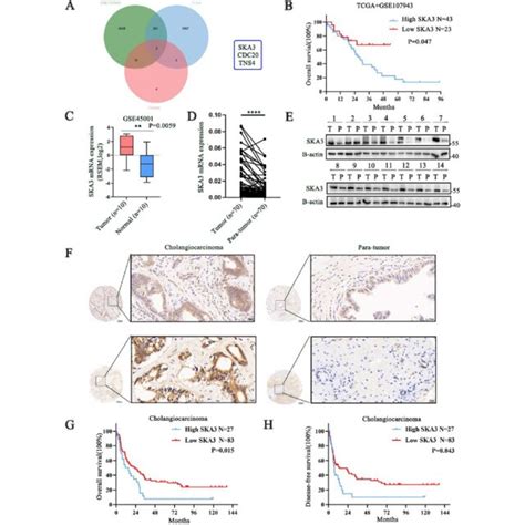 Ska3 Was Highly Expressed In Cca And Associated With Poor Prognosis A