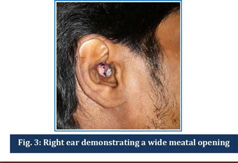 Figure 3 From Discharging Mastoid Cavity A Clinical Analysis