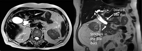 Distal Bile Duct Stricture With Upstream Dilatation Download