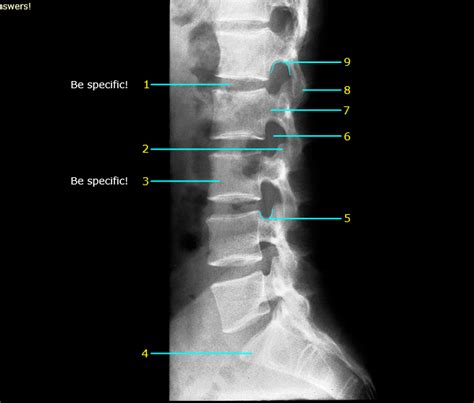 Abdomen Lumbar Spine Lateral View 4 Diagram Quizlet