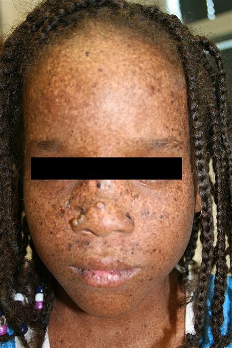 Treatment Xeroderma Pigmentosum What Is Xeroderma Pigmentosum Pt