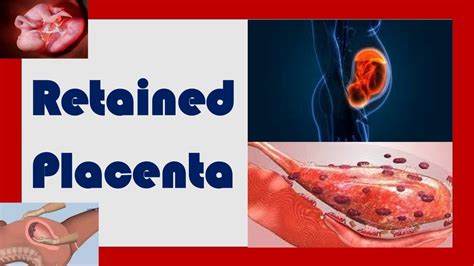 Retained Placenta Clinical Scenario Causes And Management Toacs