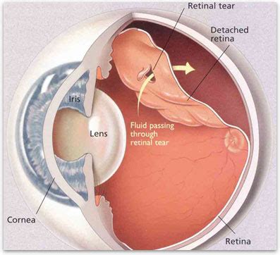 Detached Retina After Cataract Surgery