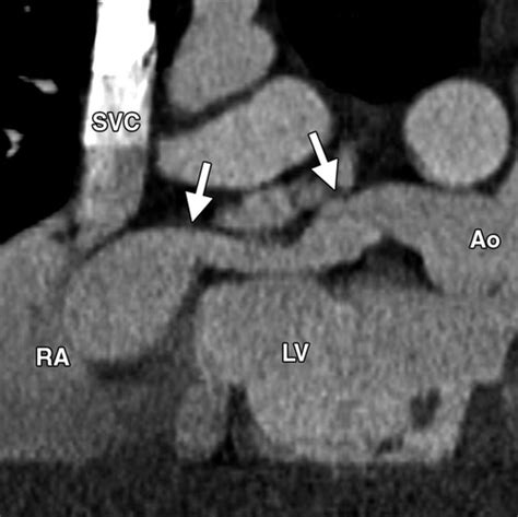 Coronary Artery Aneurysms And Ectasia Role Of Coronary Ct Angiography