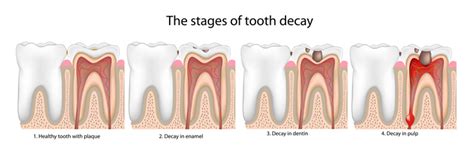 Tooth Decay Causes and Effects | Joshua Hong DDS | Dentagama