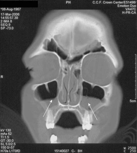 Acute Sinusitis X Ray