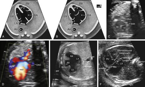 Sonographic Evaluation Of The Fetal Heart Radiology Key