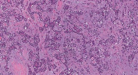 Pleomorphic adenoma | Ottawa Atlas of Pathology