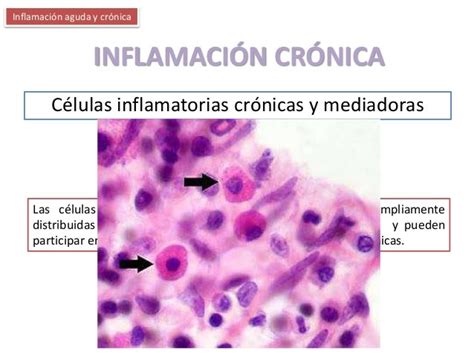 Inflamación Aguda Y Crónica