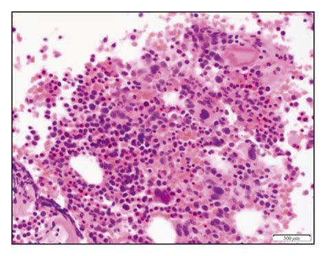 A Bone Marrow Aspirate A And Core Biopsy B Showing A Hypercellular