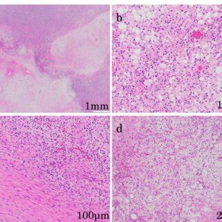 Microscopic Findings Of The Tumor Hematoxylin And Eosin Staining A