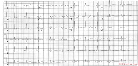 Posterior Myocardial Infarction Ecg