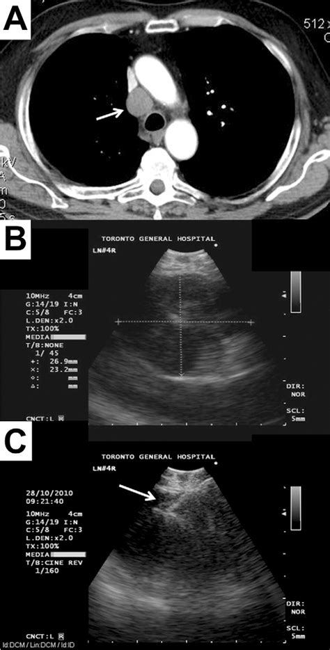 Figure 1 From Endobronchial Ultrasound Guided Transbronchial Needle