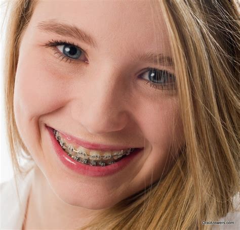 60 Photos Of Teenagers With Braces Robweigners Blog