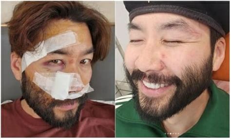 오토바이 사고 노홍철 처참했던 안면부상 얼굴 공개 Zdnet Korea