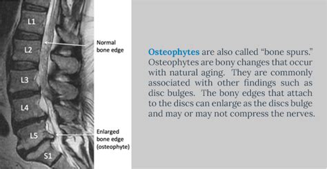 Understanding Your MRI of the Lumbar Spine