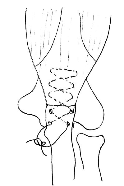 Endobutton Fixation Of Distal Biceps Tendon Is Whip Stitched To