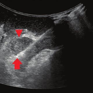 Intraoperative ultrasound directly onto the renal capsule shows the ...