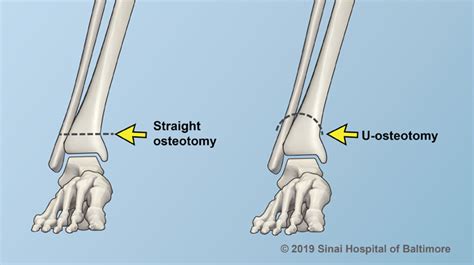 Osteotomy International Center For Limb Lengthening