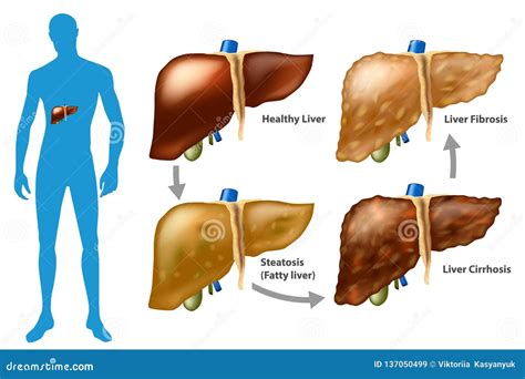 Stages Of Liver Damage From Healthy Fatty Liver Fibrosis Cirrhosis