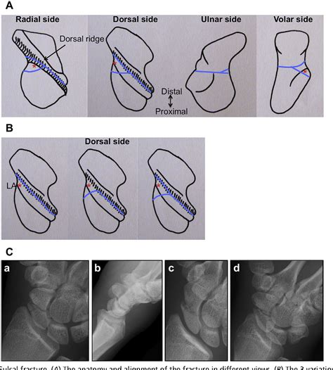 Figure 1 From Minimal Invasive Management Of Scaphoid Fractures From