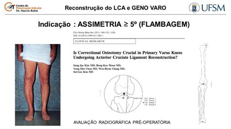 Aula Reconstrucao Lca E Osteotomia Centro De Preserva O Articular