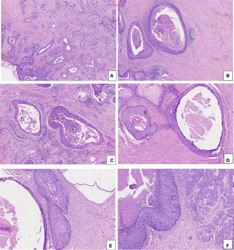 Frontiers Diagnostic Validity Of P16 E Cadherin Cyclin D1 P53 And