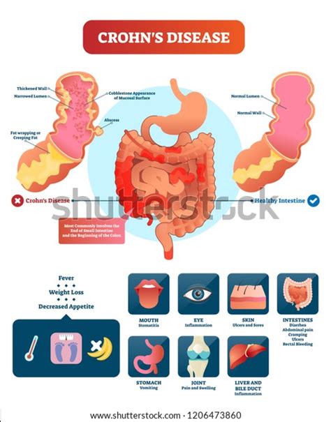 Crohns Disease Vector Illustration Labeled Diagram With Diagnosis And