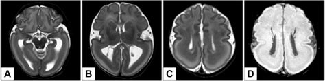 Lissencephaly Mri