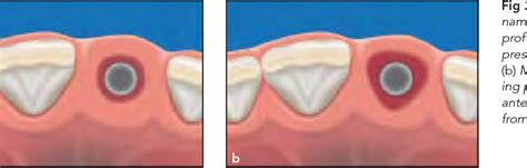 Figure 2 From Peri Implant Soft Tissue Conditioning With Provisional Restorations In The