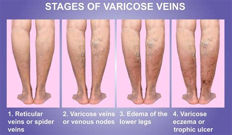 Varicose Vein Danger Baseline Of Health Foundation