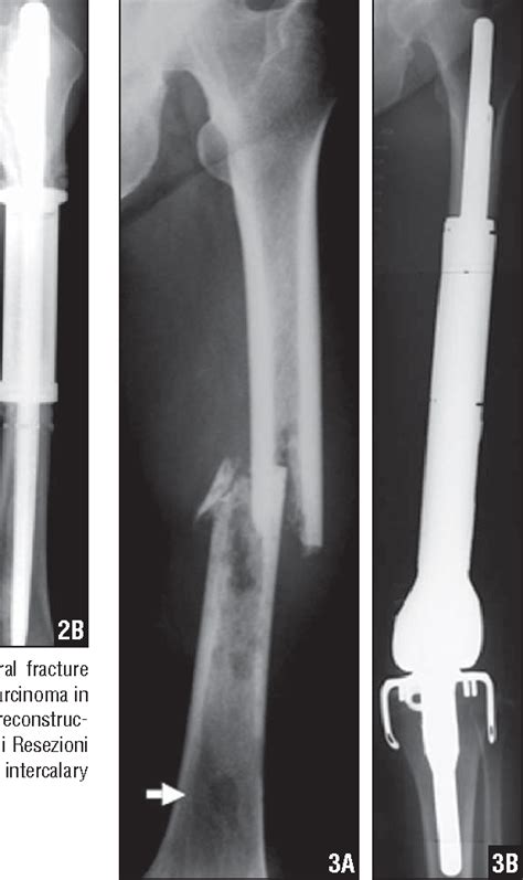 Figure From Modular Megaprosthesis In Metastatic Bone Disease Of The