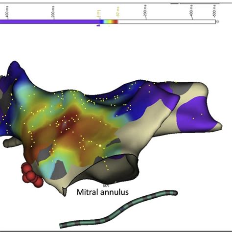 Shows D Electro Anatomical Activation Map In Lao View With His