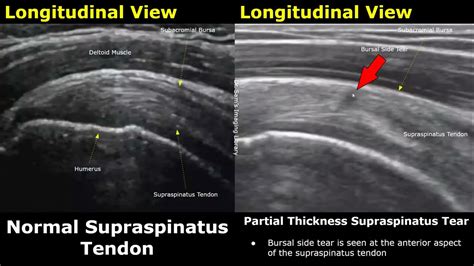 Shoulder Ultrasound Normal Vs Abnormal Image Appearances Sports Injuries Musculoskeletal Usg