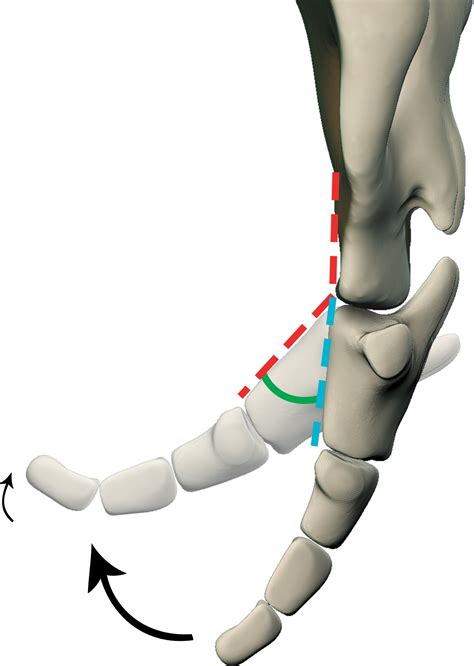 Imaging Coccygeal Trauma And Coccydynia Radiographics