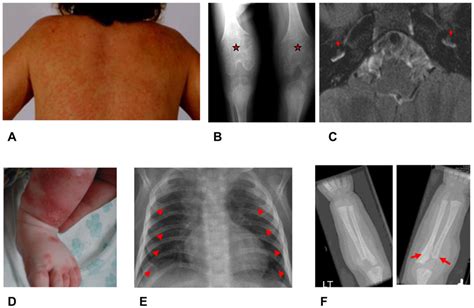 Clinical Manifestations Of Nomid And Dira Images A Through C Clinical