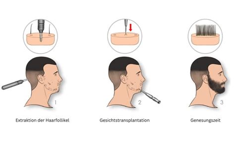 Bart und Schnurrbarttransplantation Türkei Verfahren Kosten 2024