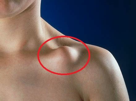 Lump On Collarbone Causes Symptoms Treatment For Clavicle Lumps