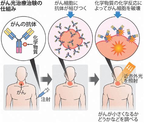 がん細胞を攻撃「光免疫療法」が先駆け審査指定 早期の実用化へ向け 毎日新聞