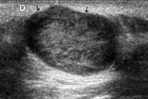 Epidermal Cysts In The Superficial Soft Tissue Huang 2011 Journal Of Ultrasound In