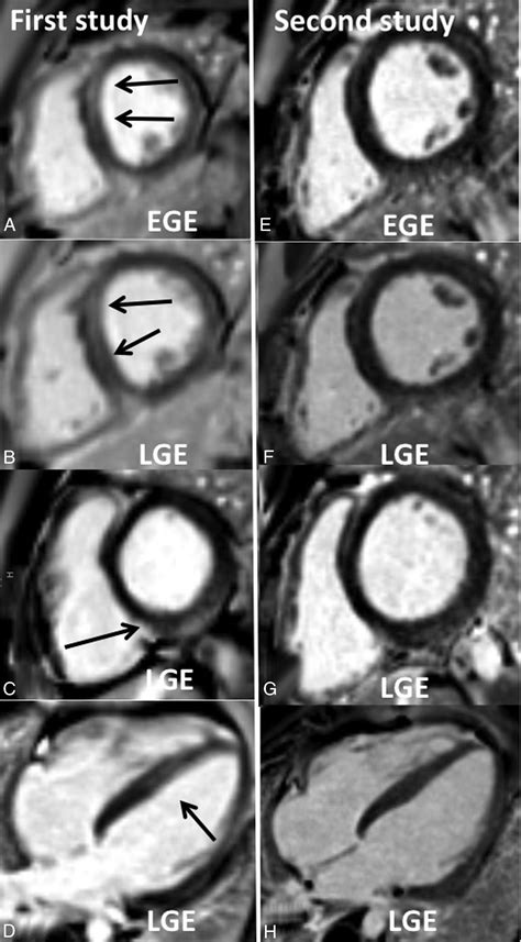 Junctional Ectopic Tachycardia Secondary To Myocarditis Associated With