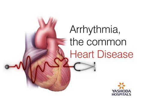 Arrhythmia Disease Symptoms Causes And Treatment